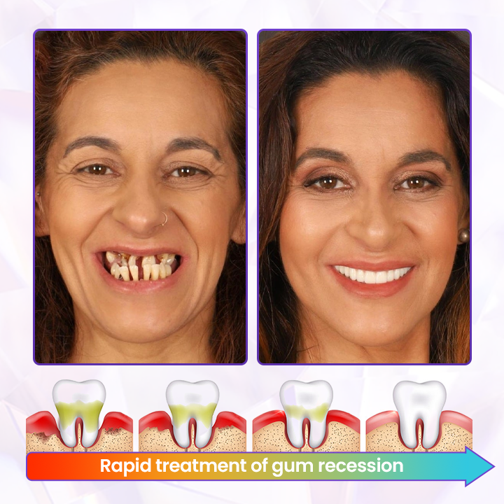 🔥NOW 50%OFF 🔥BeeRenew Advanced Gum Healing Toothpaste
