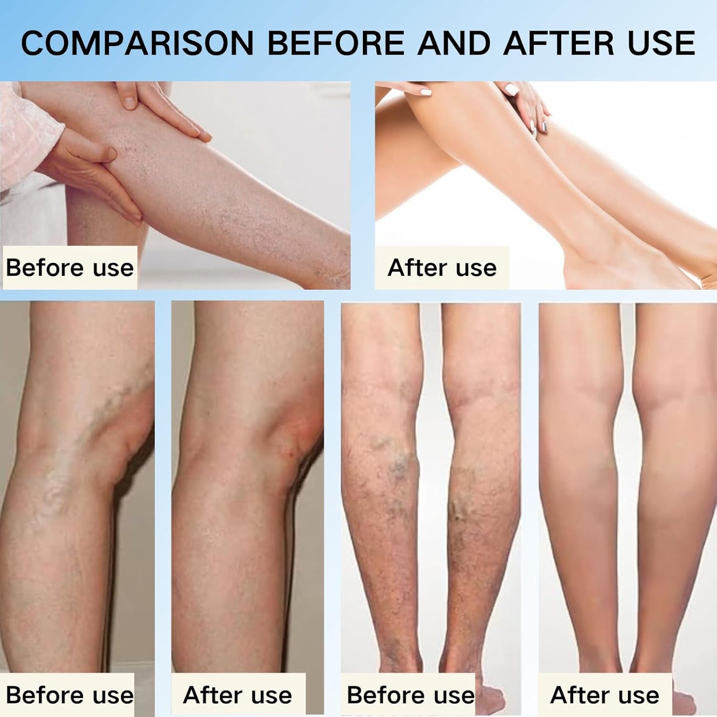 š„NOW 50%OFFš„-Veinhealing Varicose Veins Treatment Spray