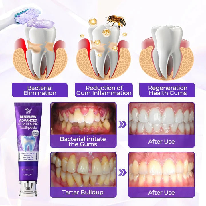 🔥NOW 50%OFF 🔥BeeRenew Advanced Gum Healing Toothpaste