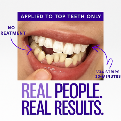 😺Whiter teeth in just 30s?! 🔥Last day 50% off - V34 Whitening Strips