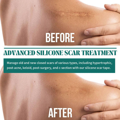 SYRGON™️-Professional Silicone Scar Sheets king- Scars Removal Treatment-Anti-Aging