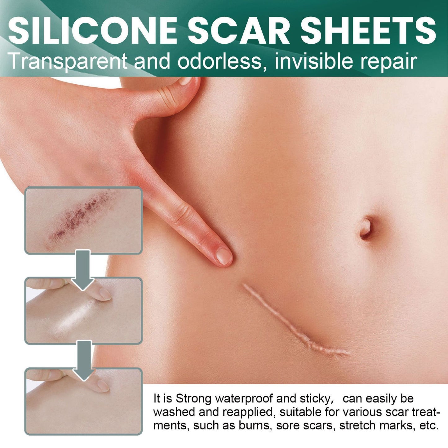 SYRGON™️-Professional Silicone Scar Sheets king- Scars Removal Treatment-Anti-Aging