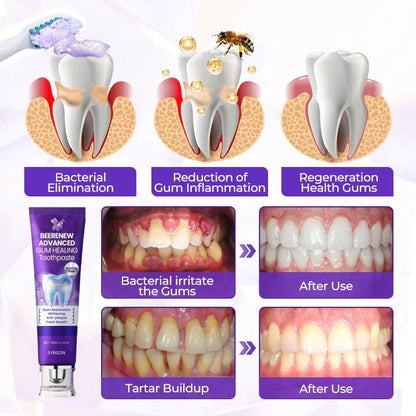 🔥NOW 50%OFF 🔥BeeRenew Advanced Gum Healing Toothpaste