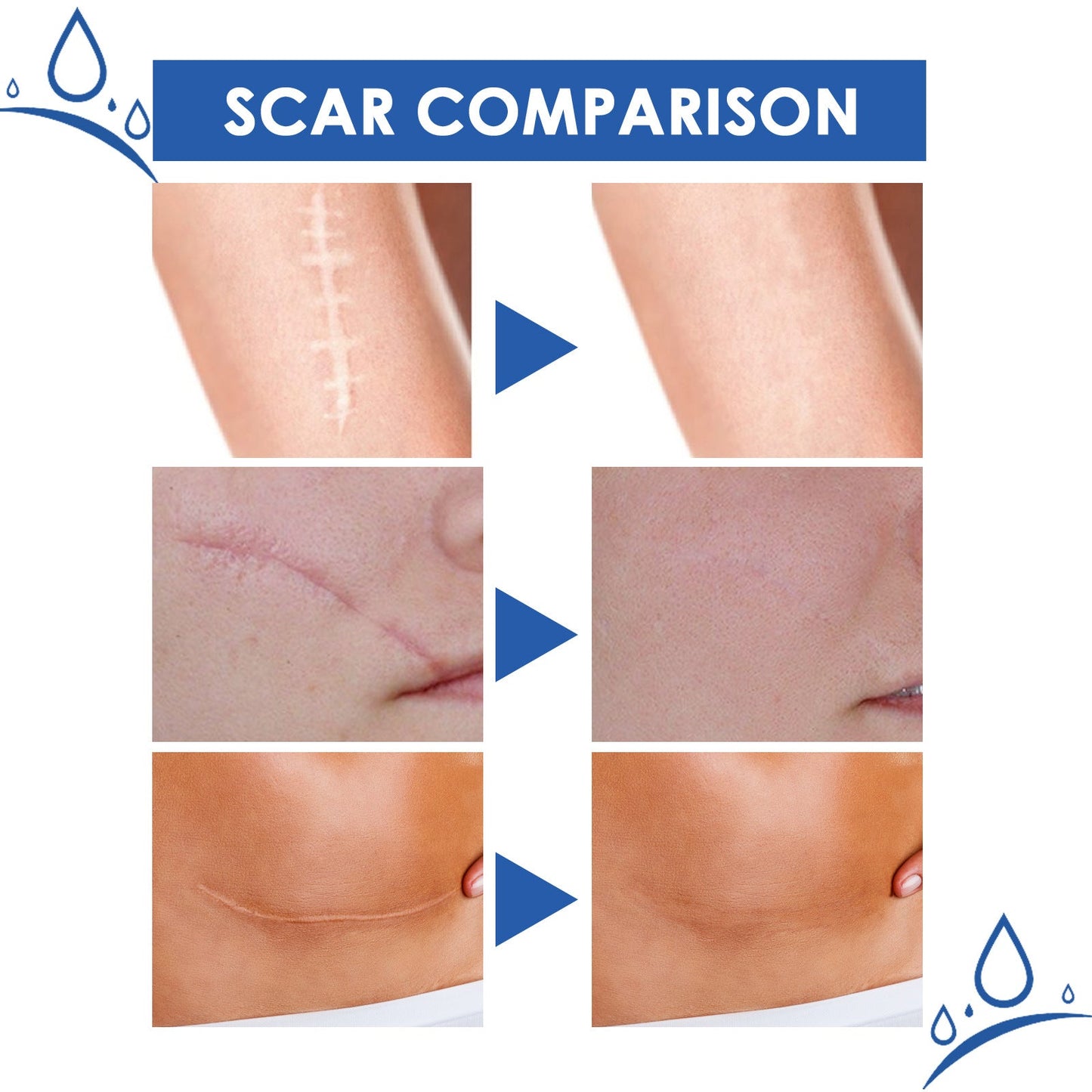 4-Day Scar Removal + 100% Refund If Not Working 🔥 50% off repair cream to smooth out blemishes!🔥