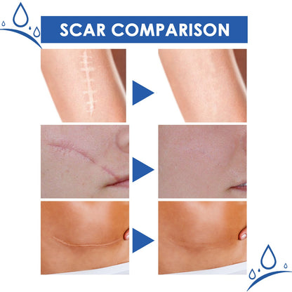 4-Day Scar Removal + 100% Refund If Not Working 🔥 50% off repair cream to smooth out blemishes!🔥