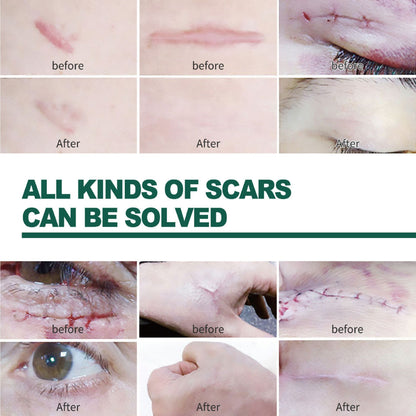 SYRGON™️-Professional Silicone Scar Sheets king- Scars Removal Treatment-Anti-Aging