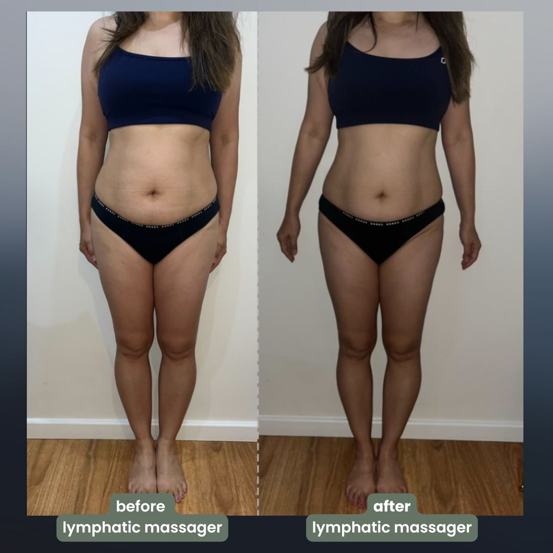 4-in-1 Massager💆‍♂️🔥 Remove Stretch Marks & Detox – Thousands Happy ✅